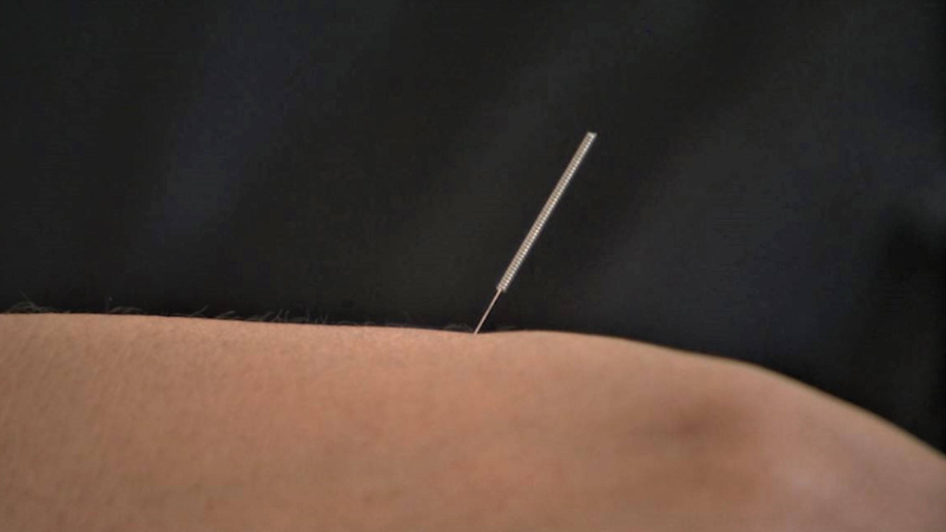 acupuncturist, metallic acupuncture needle, human skin, Full HD Desktop Wallpaper