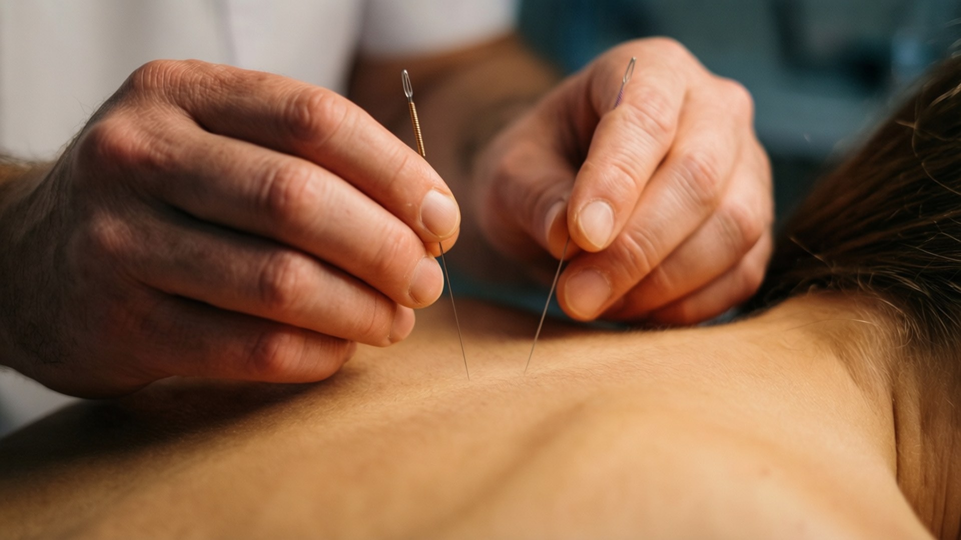 acupuncture needles, practitioner, patient's bare back, Full HD Desktop Wallpaper
