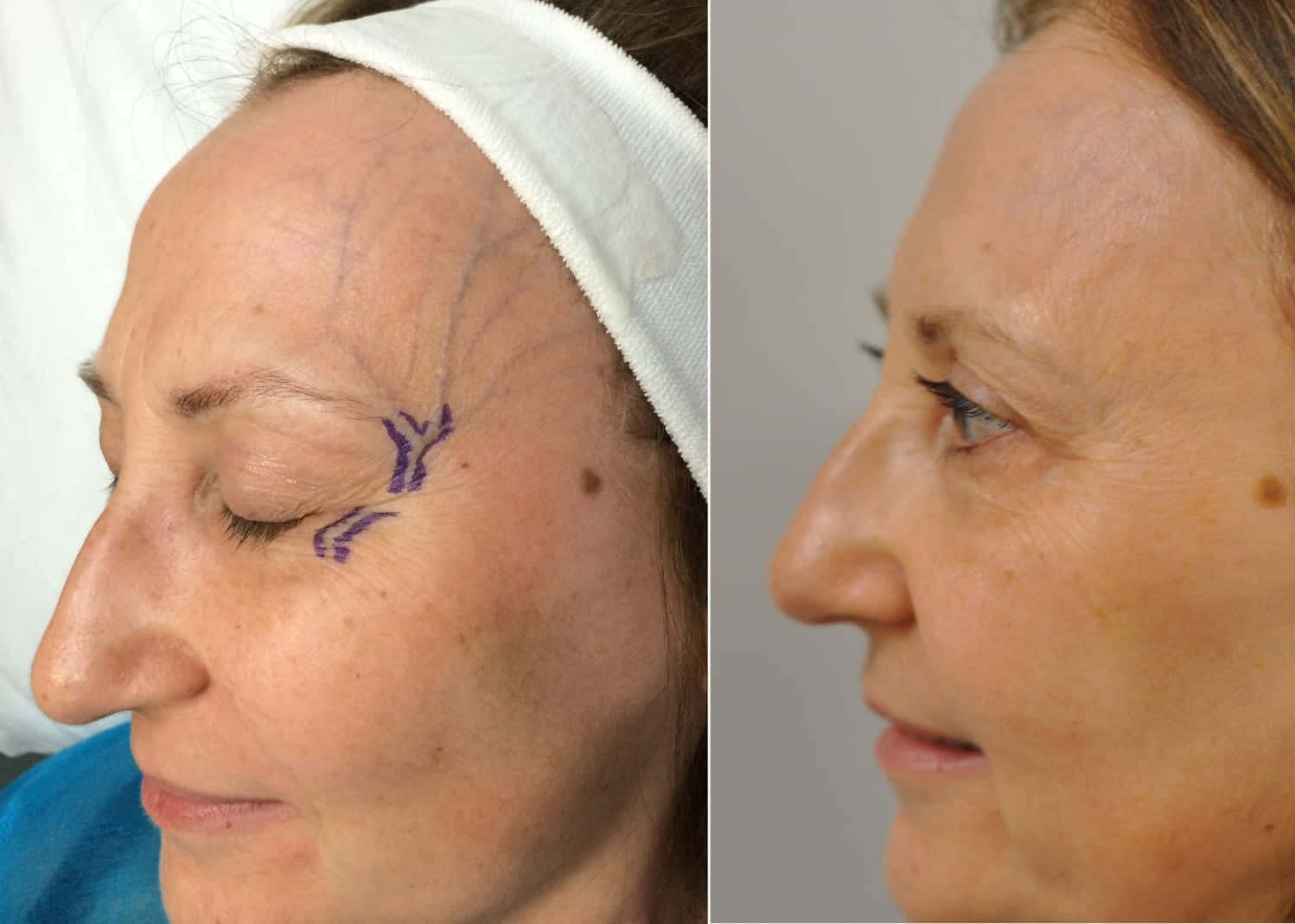 blue veins, medical comparison, woman's face, HD Desktop Wallpaper