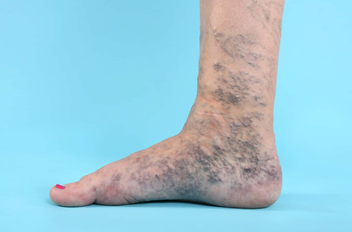 blue veins, 1434 x 946, dark purple bruises, HD Desktop Wallpaper