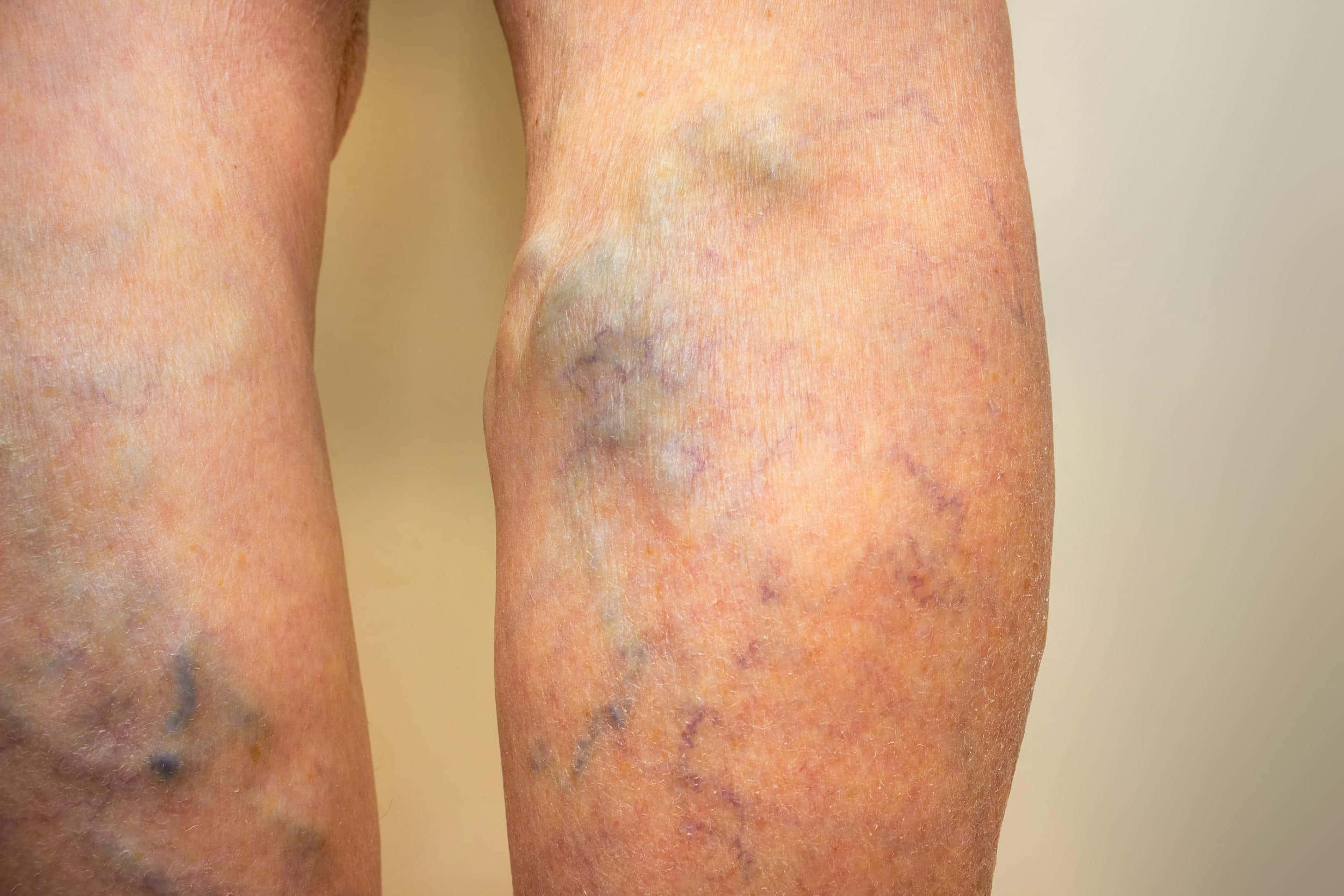 Blue Veins, varicose veins, bruising, Full HD Desktop Wallpaper