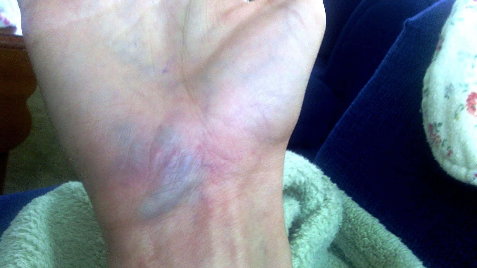 Blue Veins, human wrist, bruise, HD Desktop Wallpaper