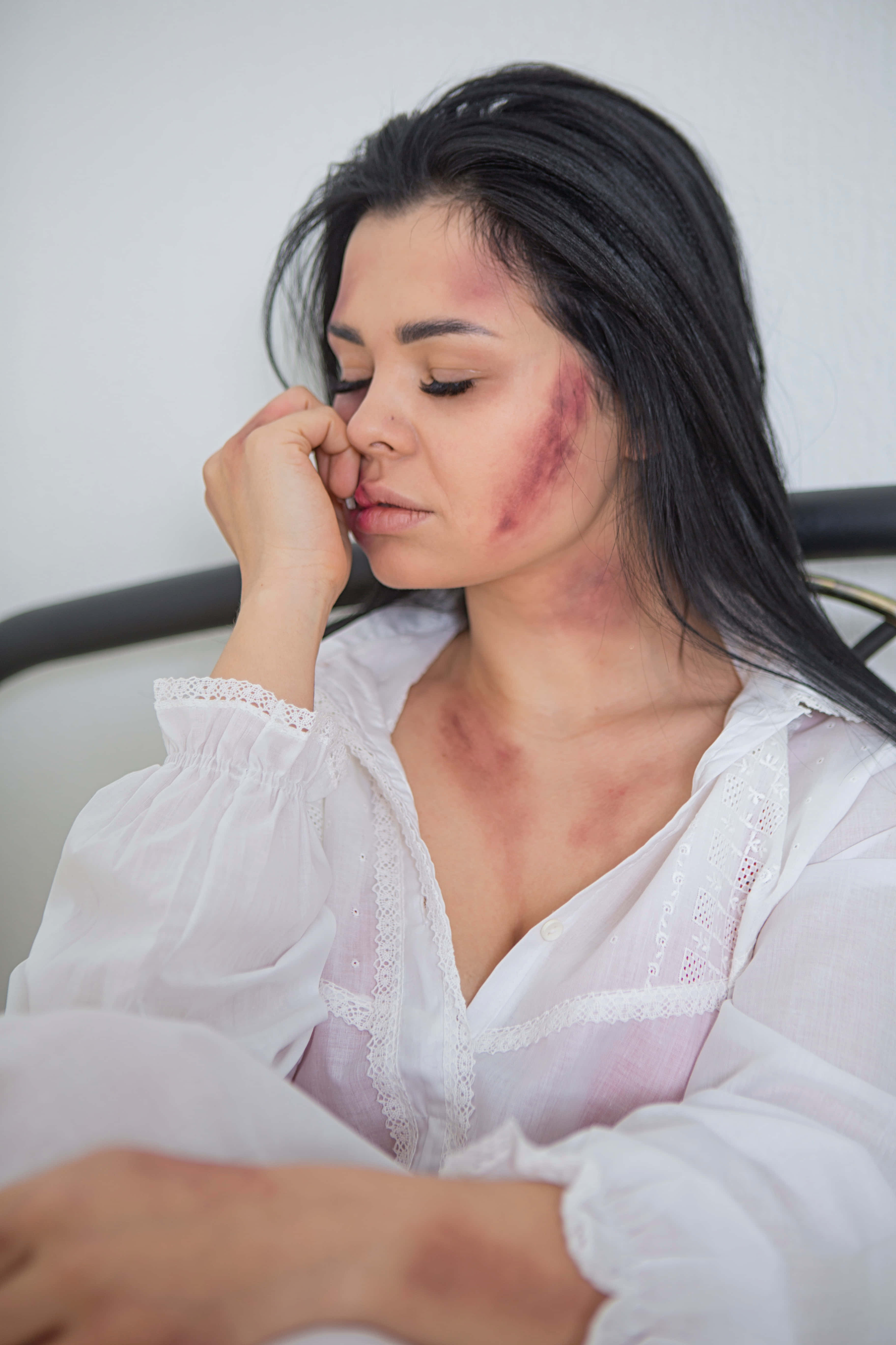 bruised girl, white polo, face bruises, 5K Phone Wallpaper