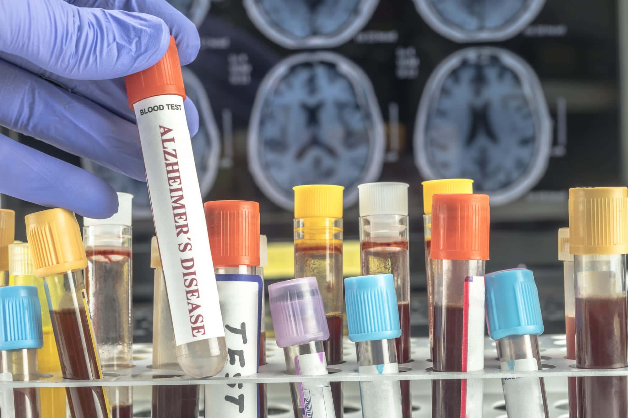 Alzheimer's disease, blood test tube, brain MRI scans, Full HD Desktop Wallpaper