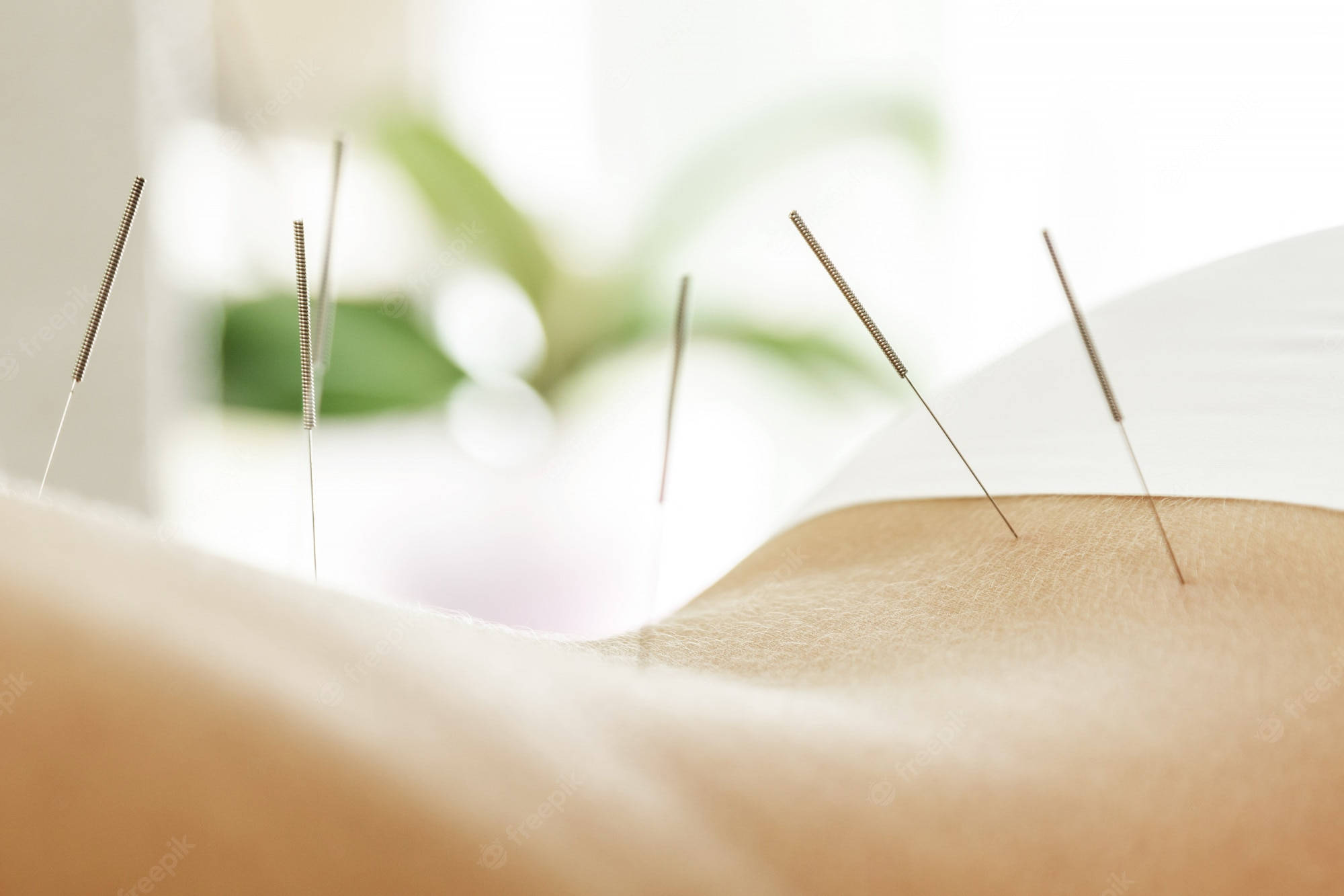 acupuncturist, back needle therapy, acupuncture needles, Full HD Desktop Wallpaper