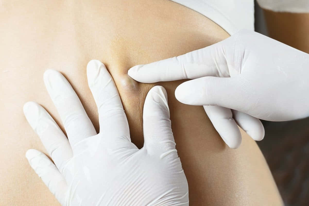 Popping Back Acne, gloved hands, close-up, SD Desktop Wallpaper