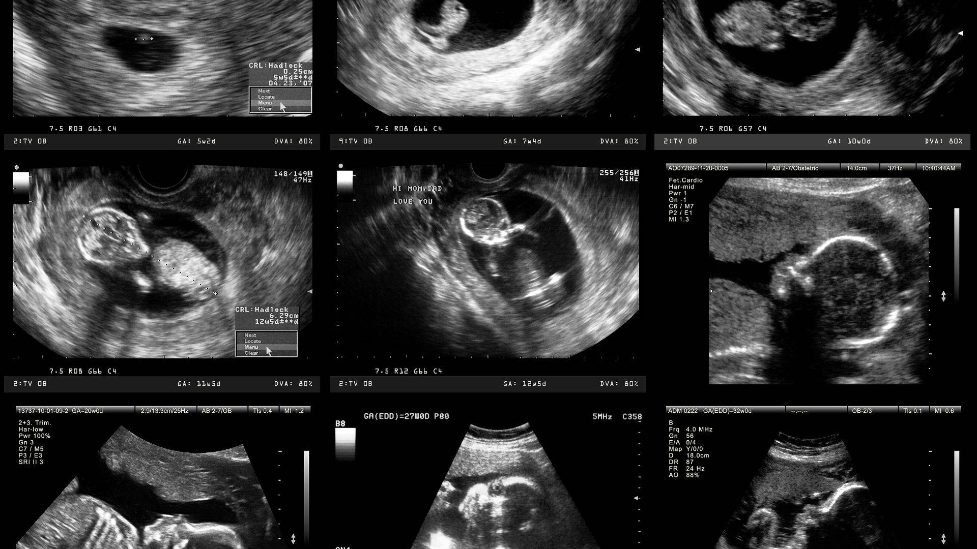 pregnancy ultrasound, grayscale ultrasound images, developing fetuses, Full HD Desktop Wallpaper