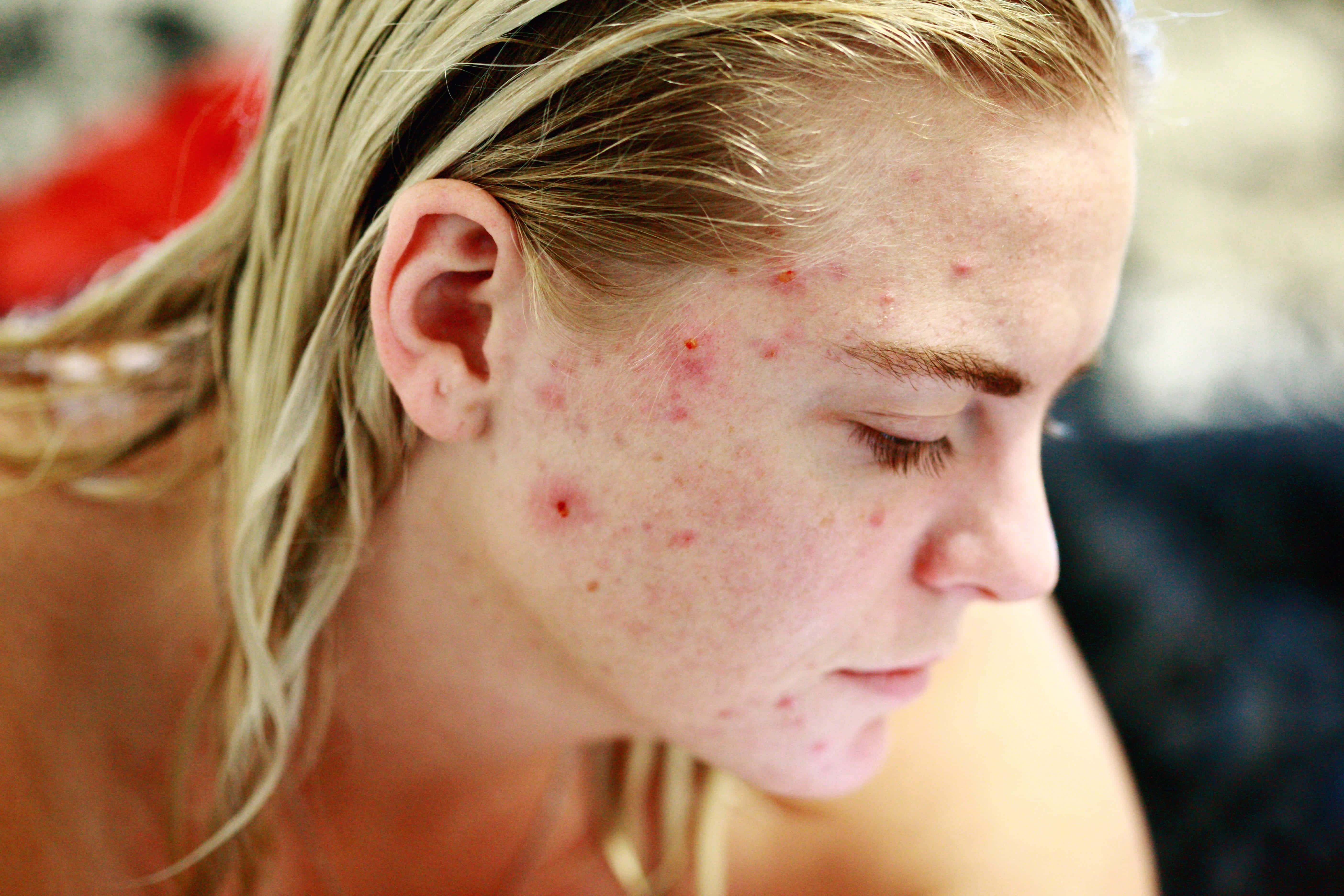 Bruised Girl, young woman, acne, 5K Desktop Wallpaper