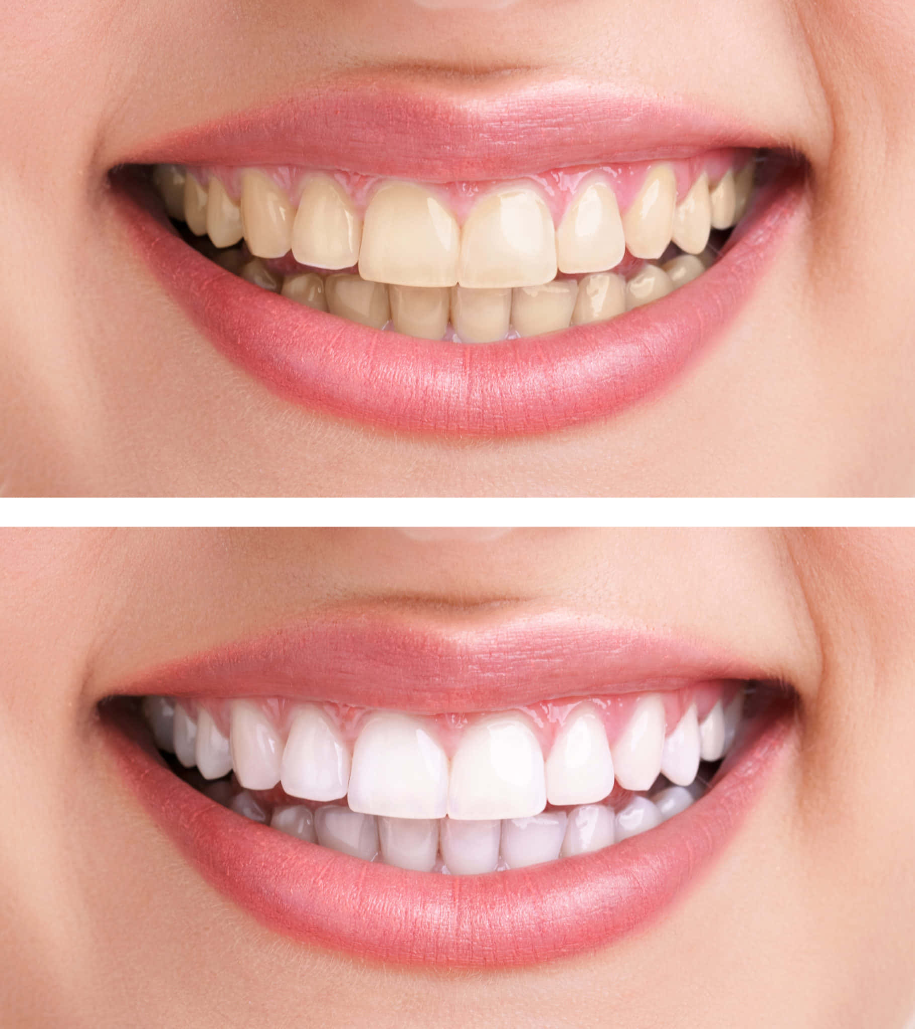 teeth whitening, bright white teeth, yellowed teeth, Full HD Phone Wallpaper