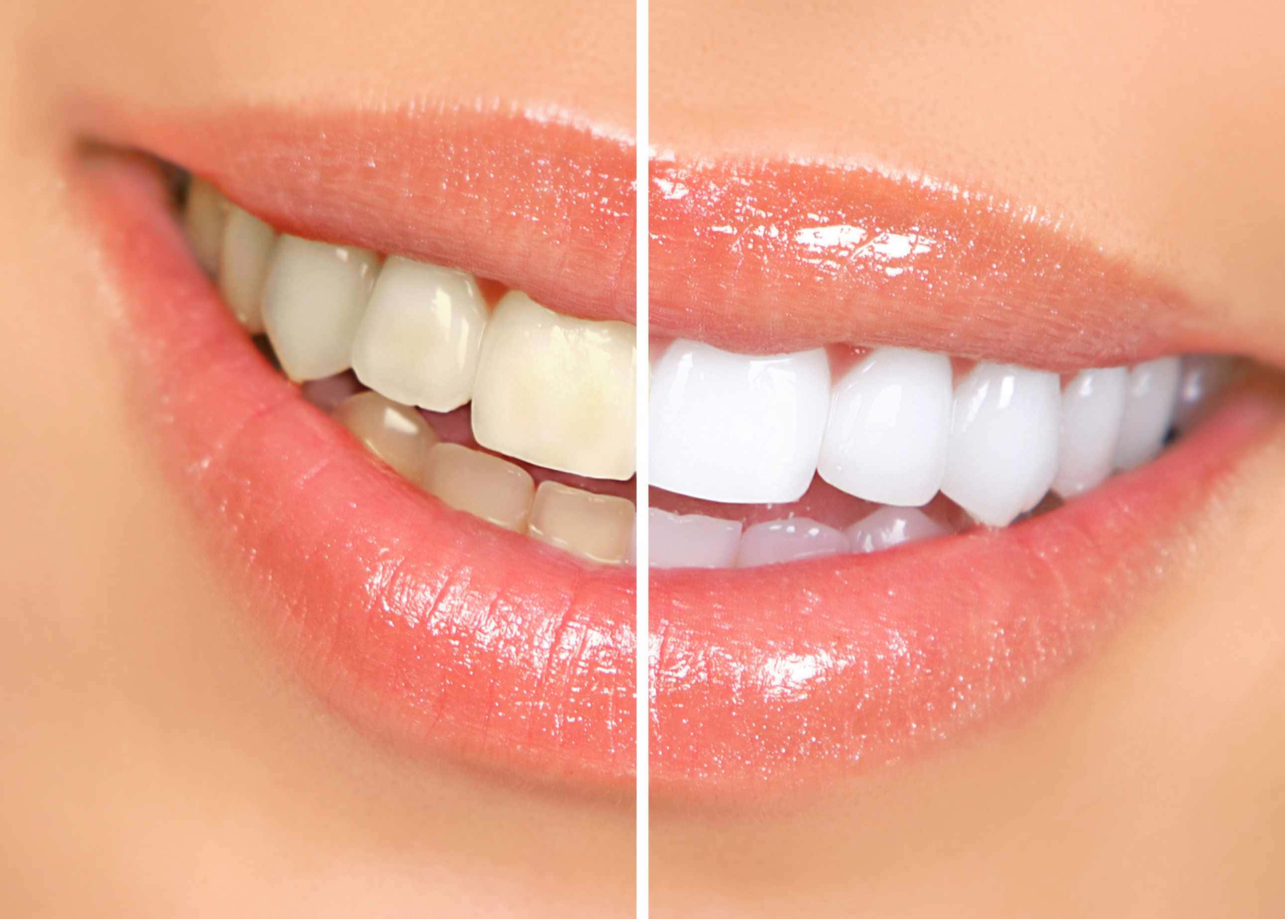 teeth whitening, smiling mouth, before and after, 2K Desktop Wallpaper