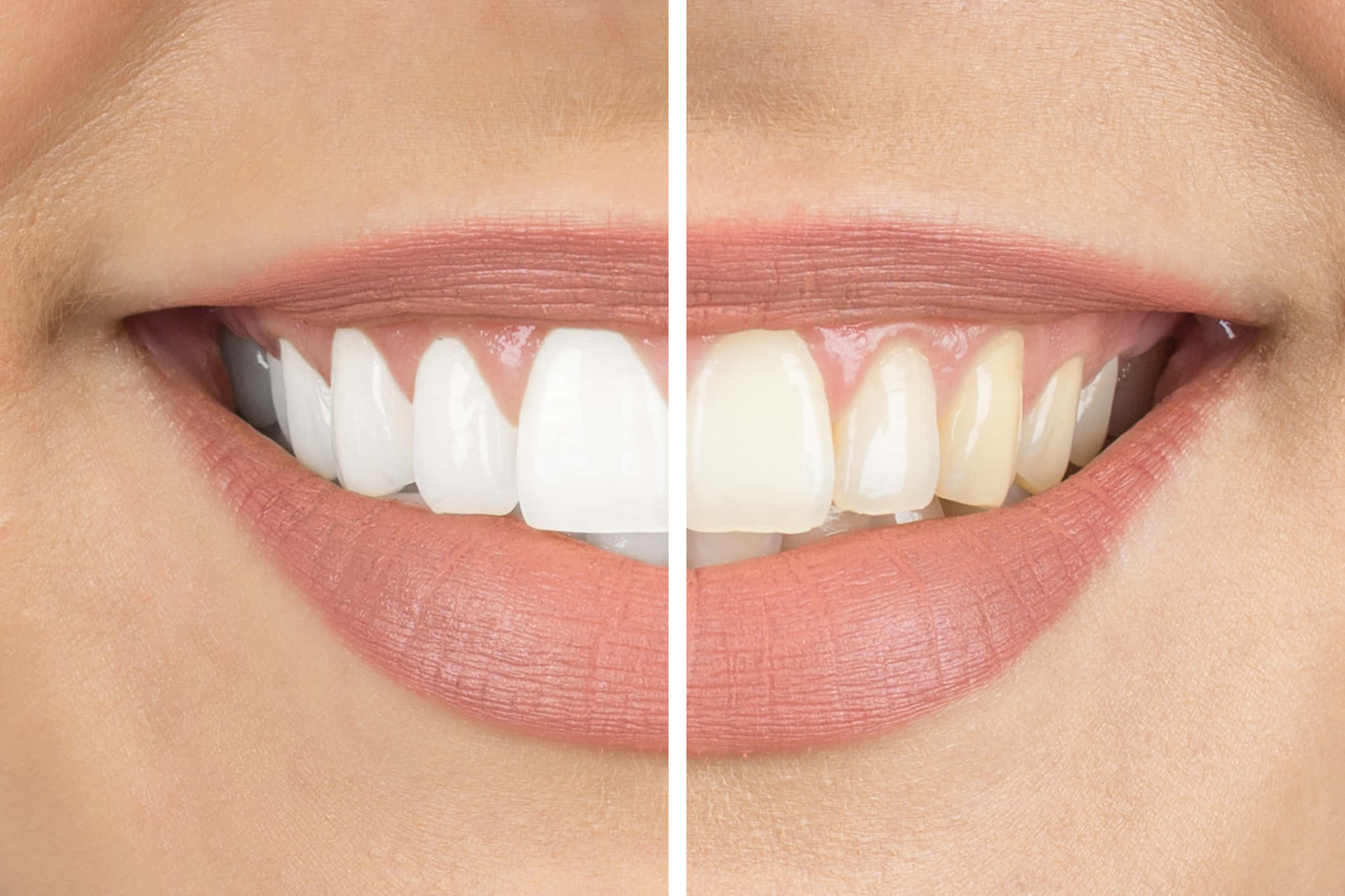 teeth whitening, split-screen, close-up, Full HD Desktop Wallpaper