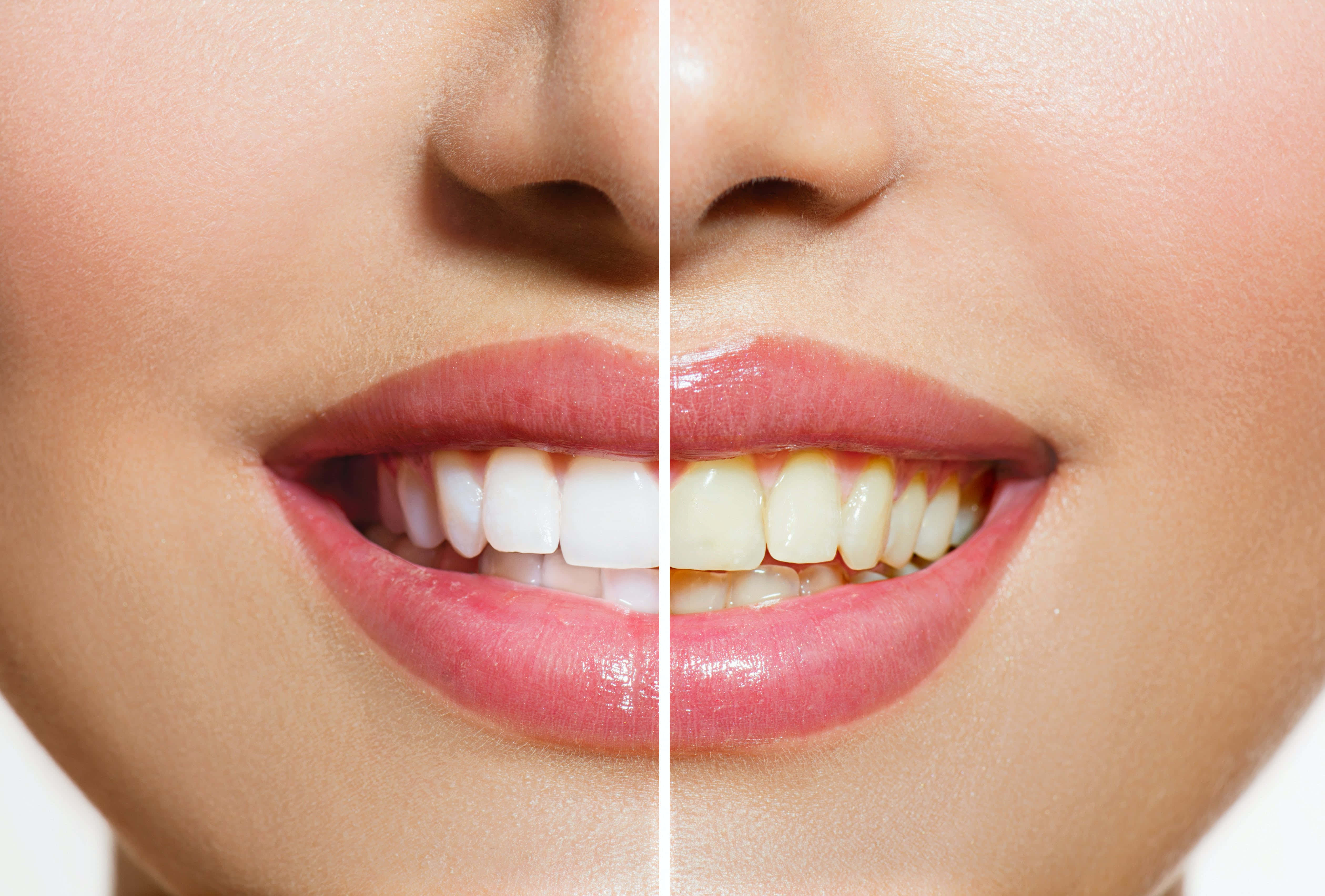 teeth whitening, woman's smile, bright white teeth, 4K Desktop Wallpaper
