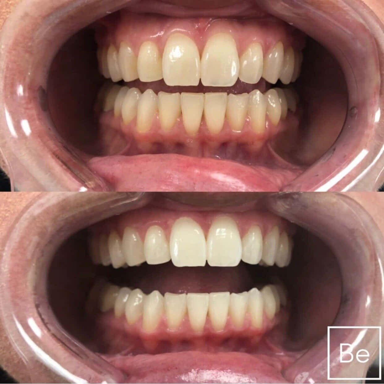 teeth whitening, porcelain white smile, dental veneer transformation, SD Desktop Wallpaper