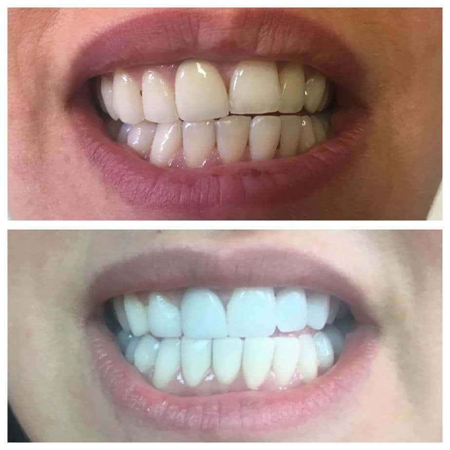 teeth whitening, bright white teeth, yellowish teeth, SD Desktop Wallpaper