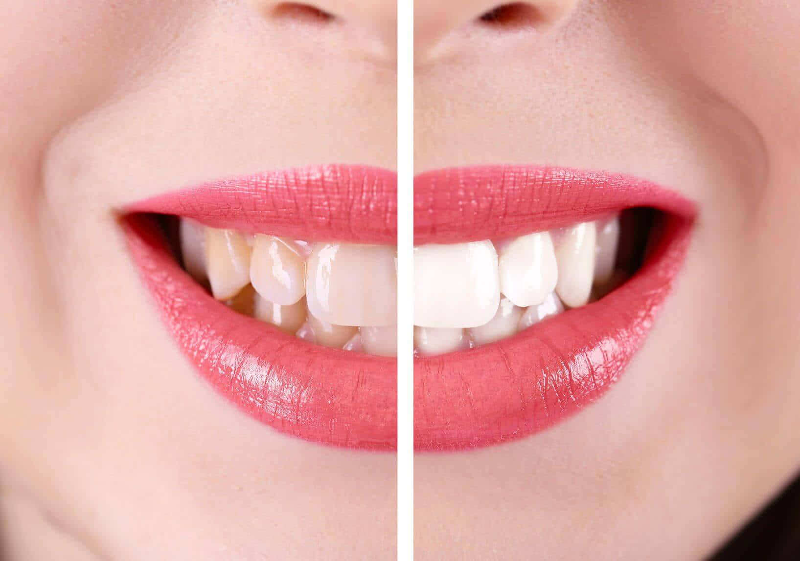 teeth whitening, pink lips, bright smile, HD Desktop Wallpaper
