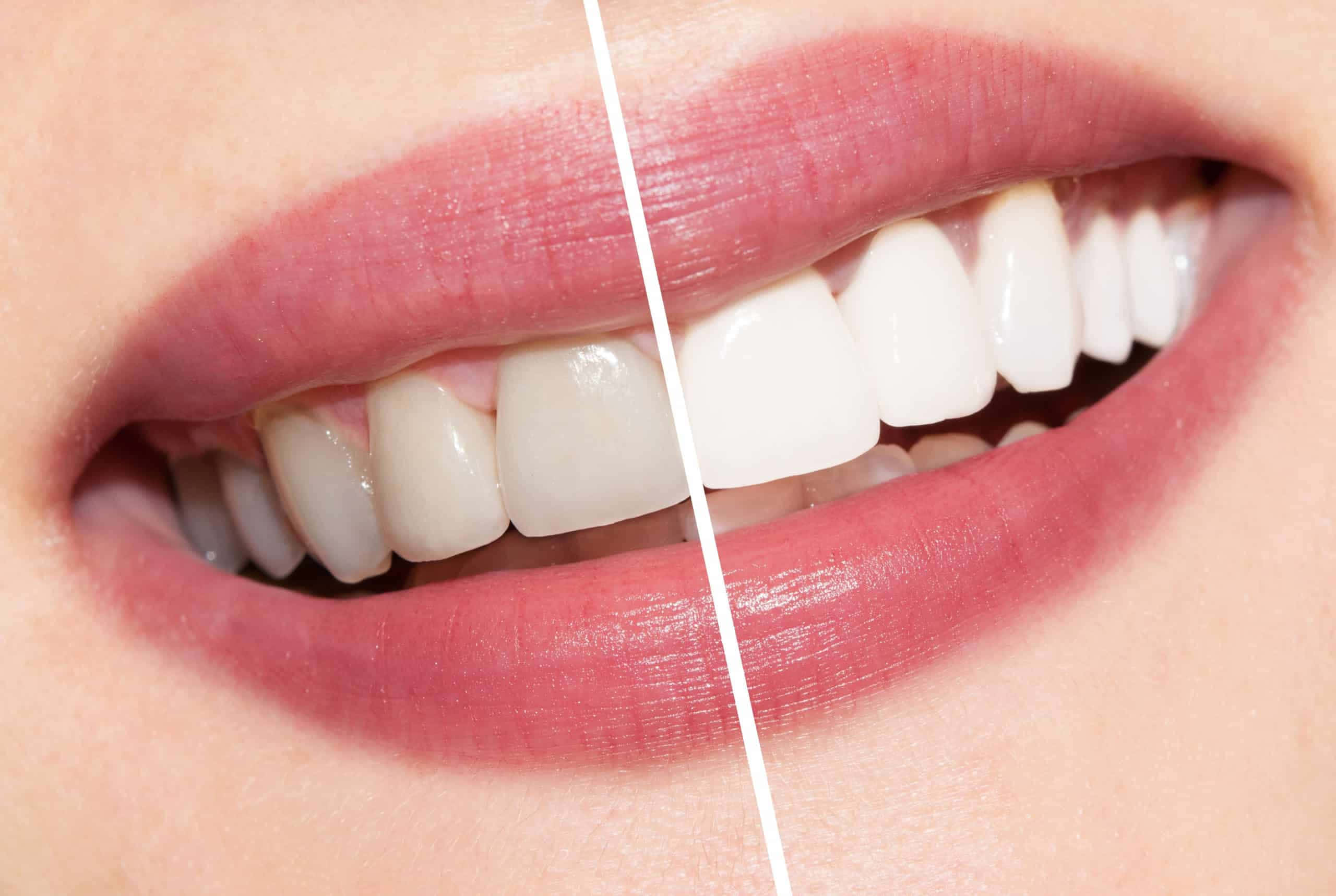Teeth Whitening, smiling mouth, natural teeth, 2K Desktop Wallpaper
