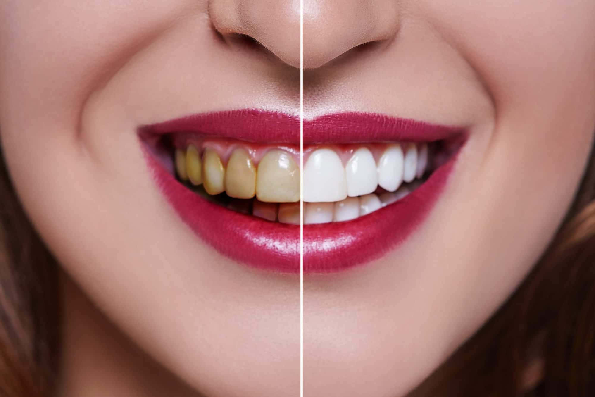 teeth whitening, yellow teeth, bright white teeth, Full HD Desktop Wallpaper
