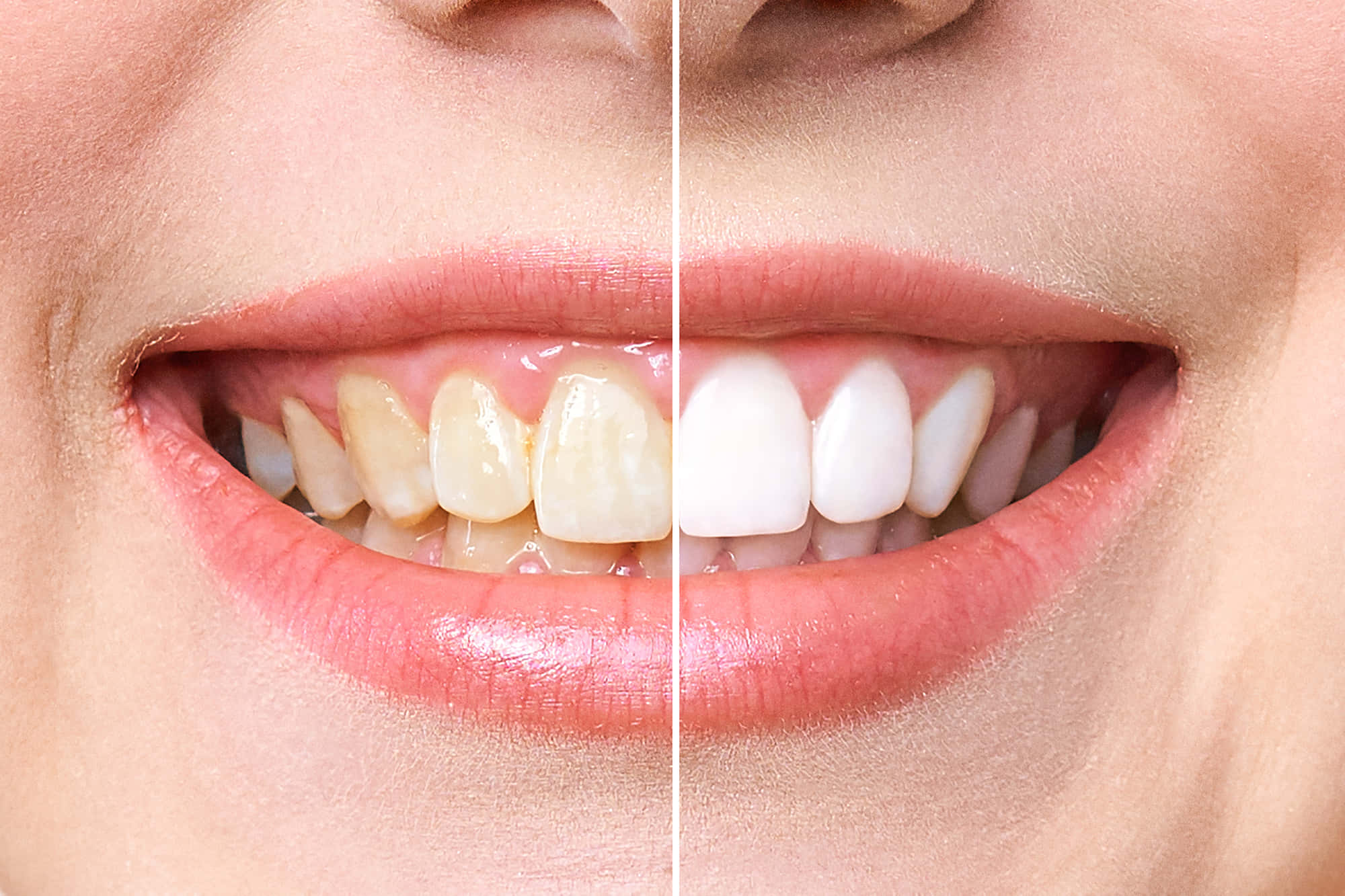 Teeth Whitening, yellow teeth, bright white teeth, Full HD Desktop Wallpaper