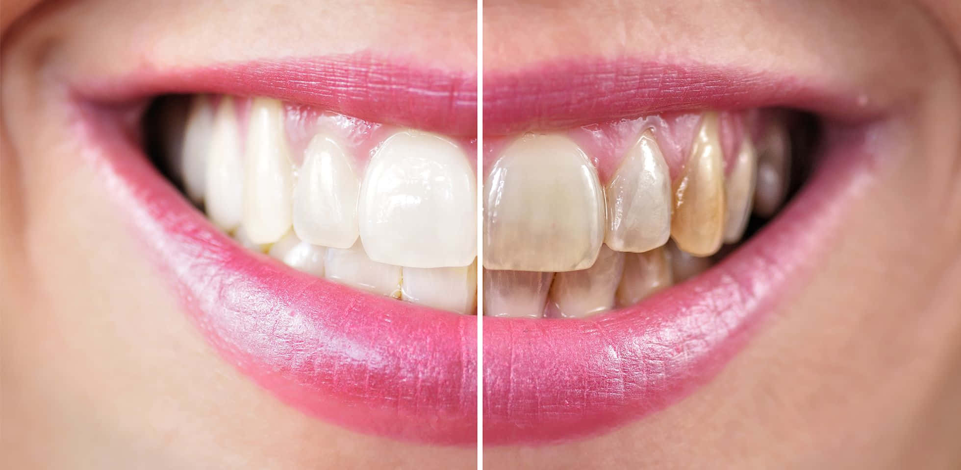 teeth whitening, smiling mouth, stained yellow teeth, Full HD Desktop Wallpaper