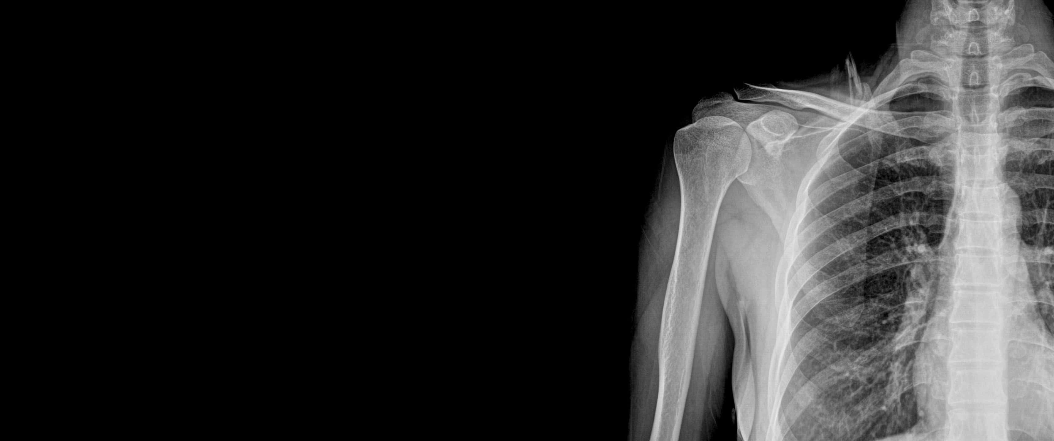 x ray, human shoulder, ribcage, 2K Desktop Wallpaper