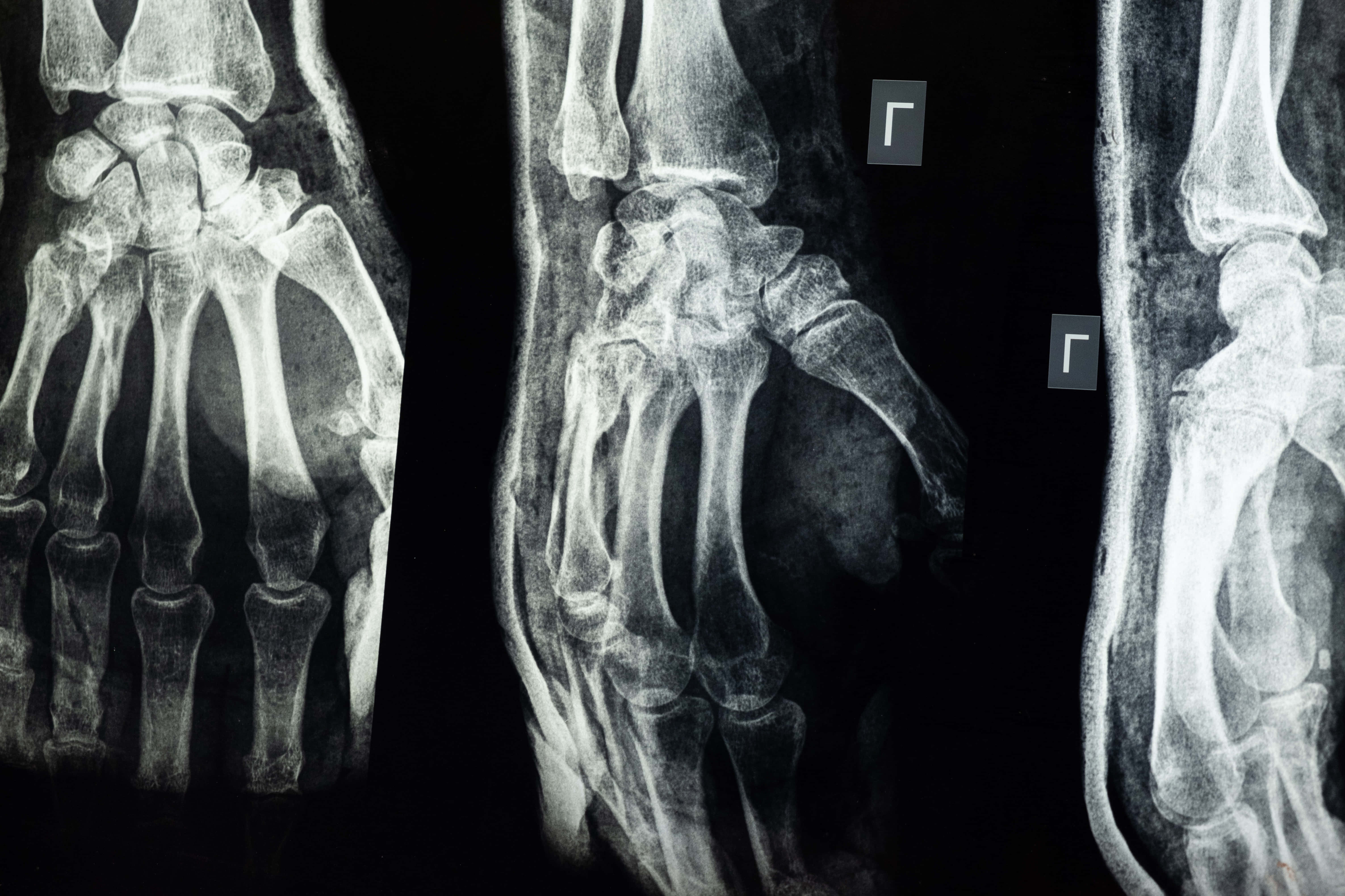 x ray, hand, wrist, 5K Desktop Wallpaper