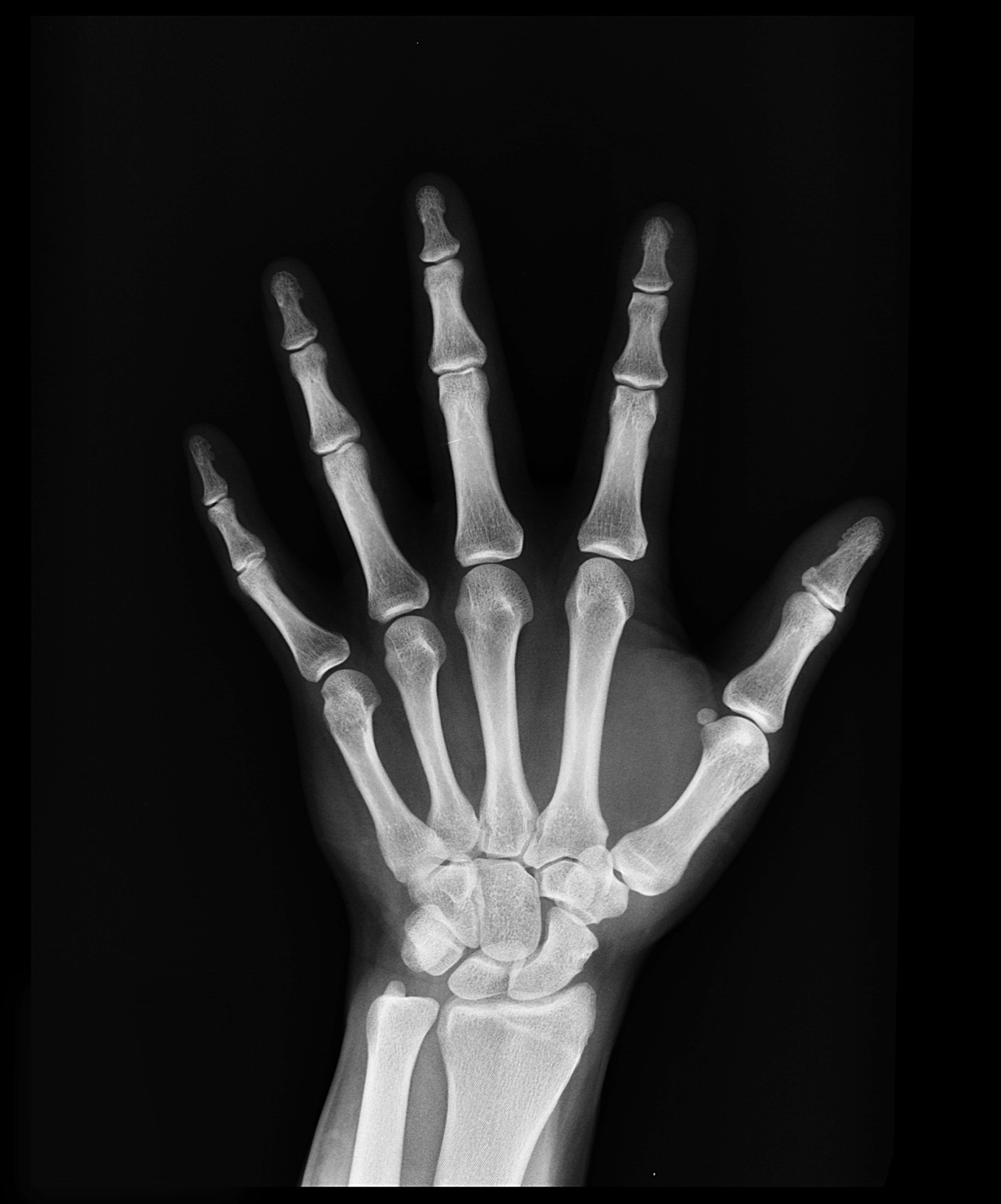 X Ray, human hand, bones, 5K Phone Wallpaper