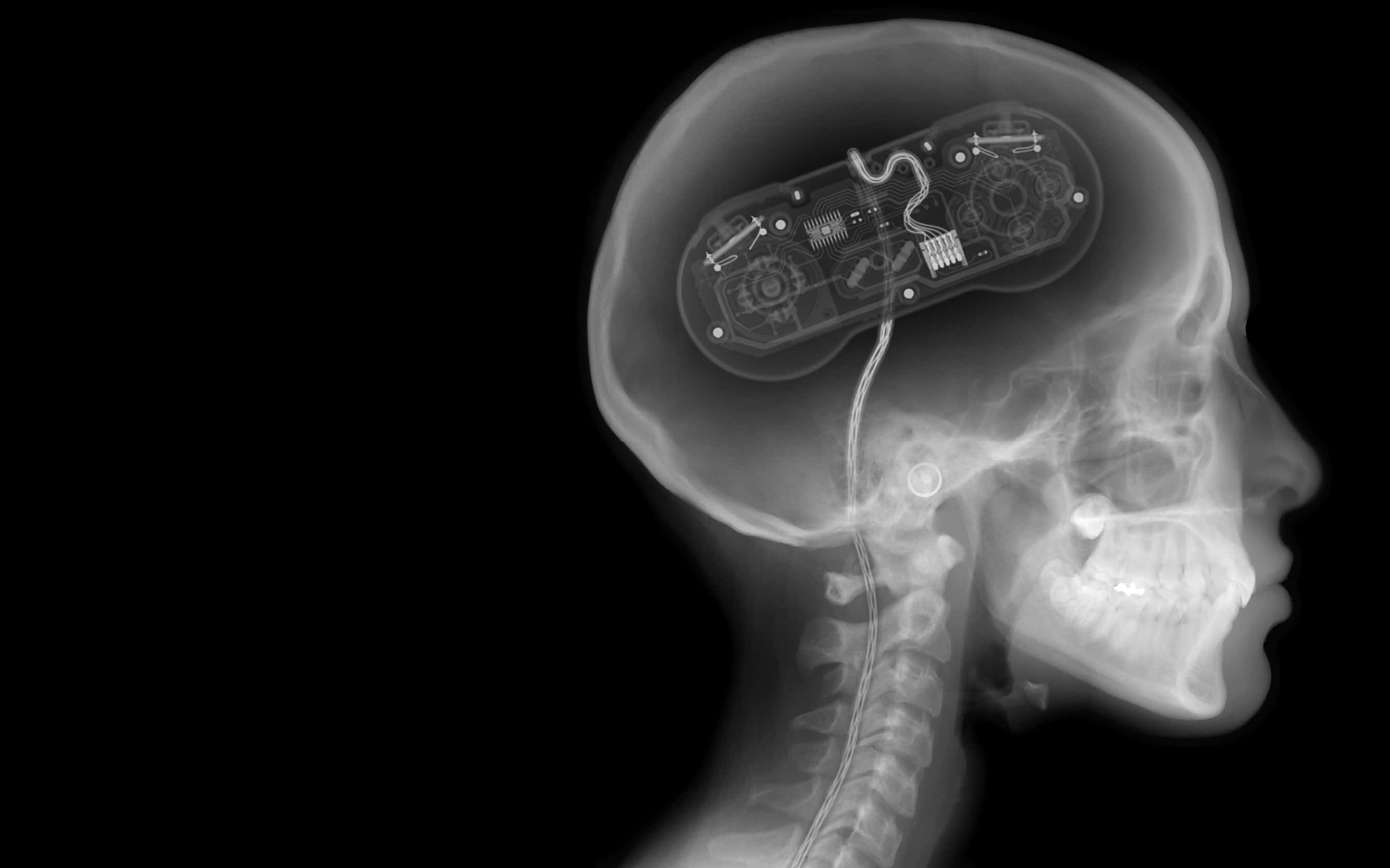 X Ray, human skull, circuit board implant, 2K Desktop Wallpaper